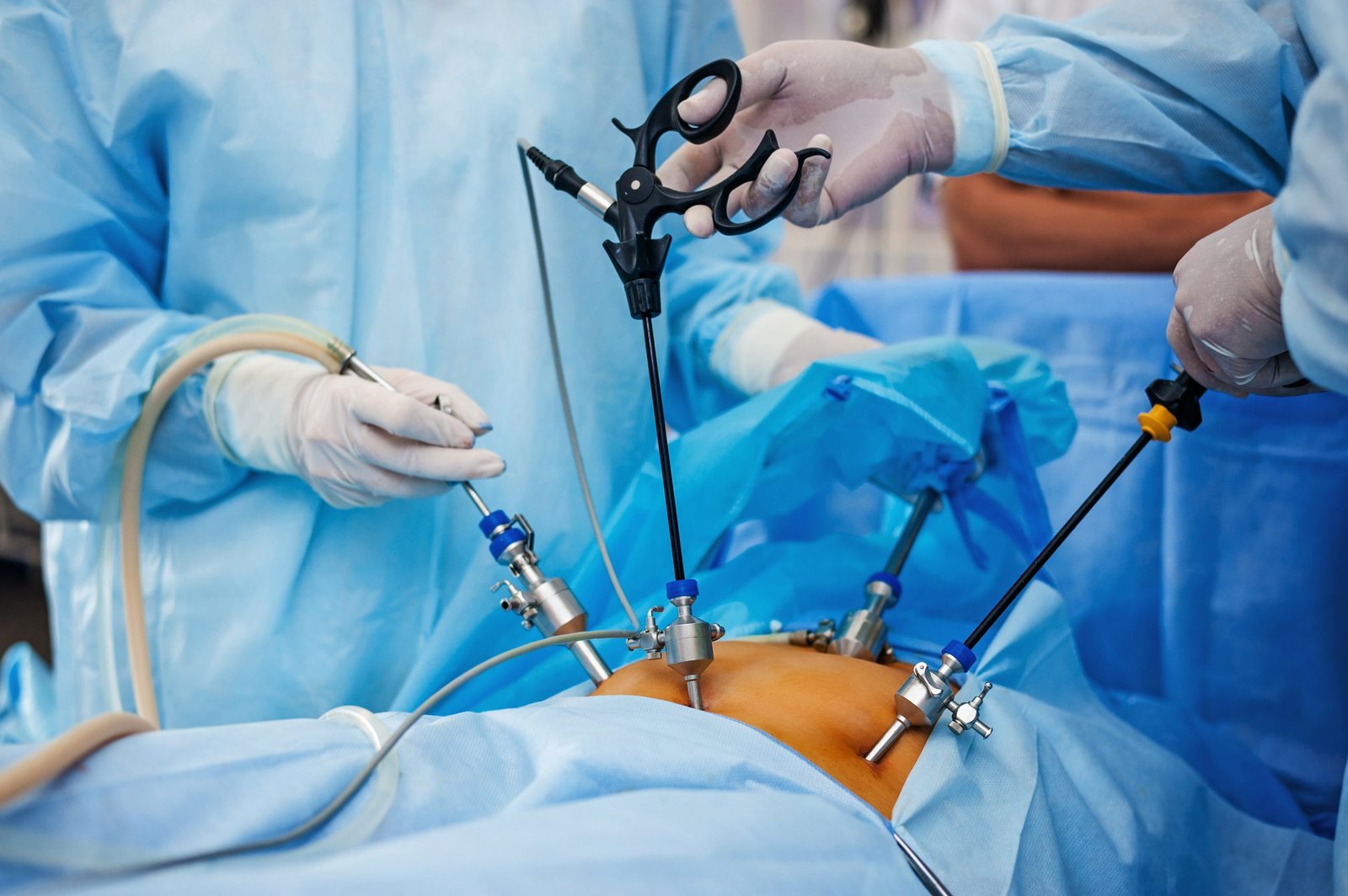 All Types of Laparoscopic Surgery